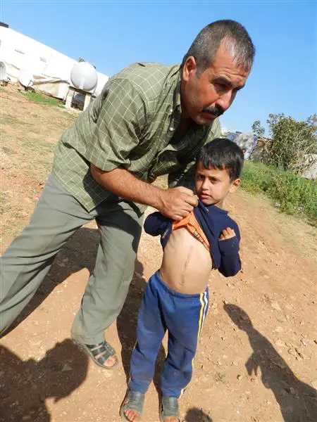 نازح يعرض طفله المصاب بمرض جلدي في المخيم (طارق أبو حمدان)