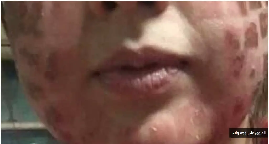 الحروق على وجه ولاء