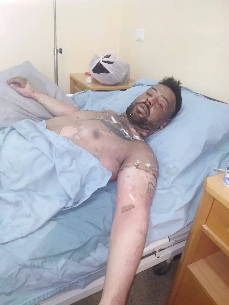 محمد بدر عتمه في مستشفى مرجعيون بعد تعرضه للحروق في جسمه ووجهه