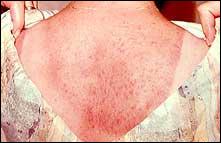 التعرض المفرط لأشعة الشمس يتسبب بأمراض جلدية